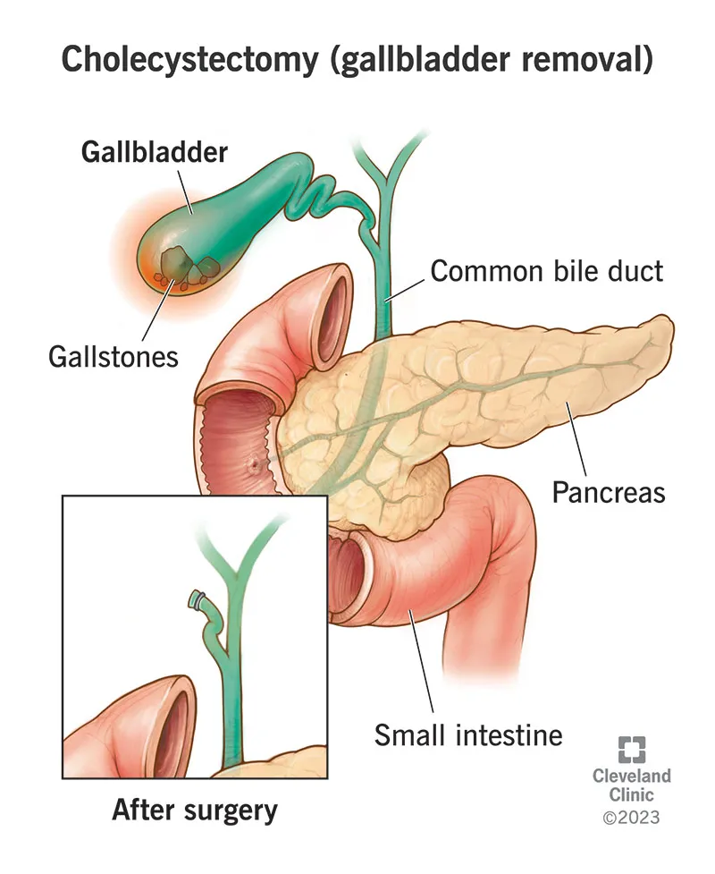 gallbladder surgery